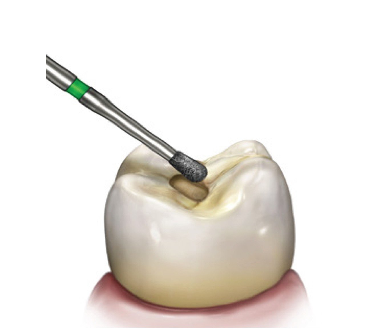 Fresa de Pera de Diamante Alta Velocidad 830-010M-D29 - Imagen 3