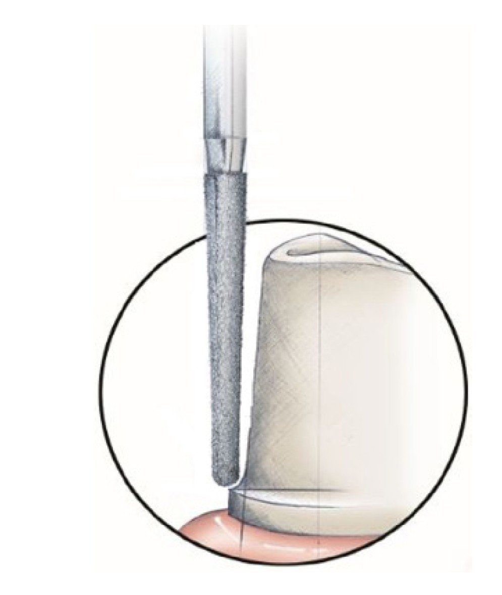 Fresa Cónica Punta Redonda Diamant Alta Veloc 855-025SC-D56 - Imagen 4