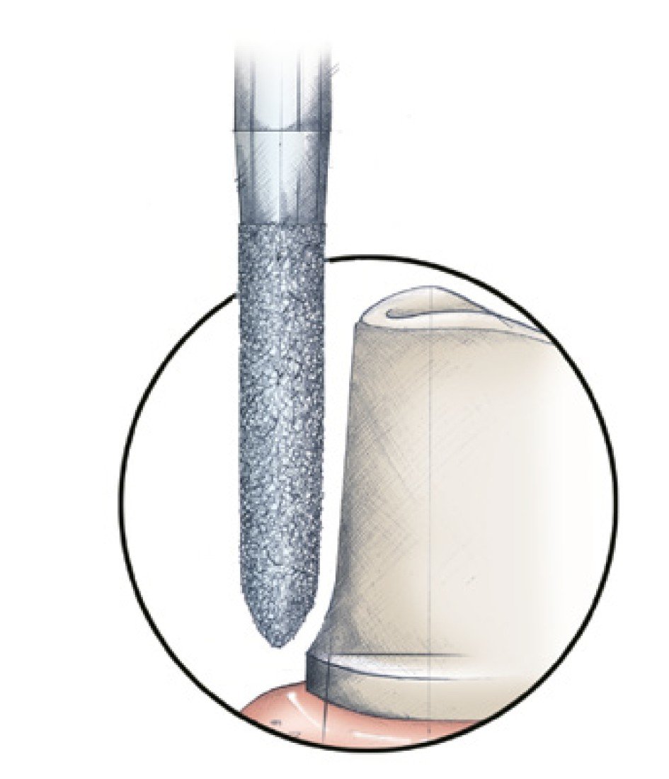 Fresa Torpedo Diamante Alta Velocidad 877-012M-D85 - Imagen 2
